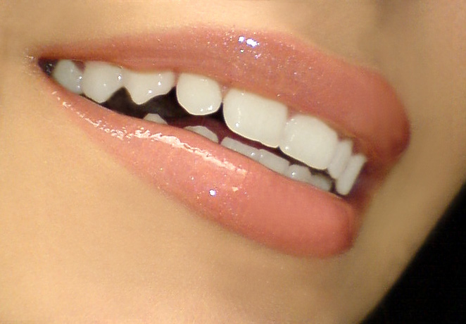 Enhance Your Smile with Dental Bonding in Ashburn, VA