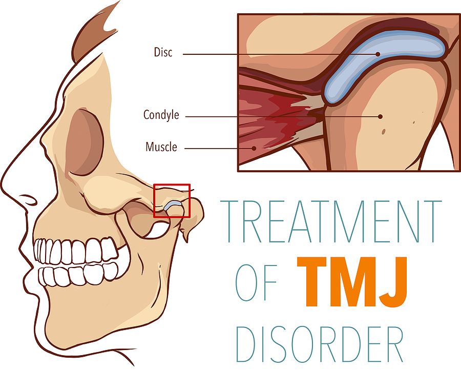 Effective TMJ Treatment in Ashburn, VA: Relieving Jaw Pain and Restoring Comfort