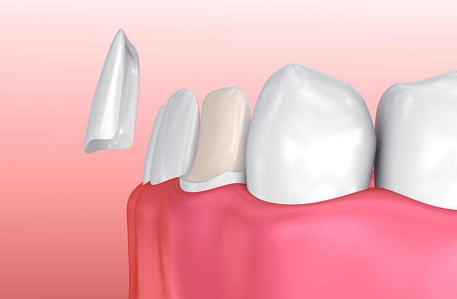Transform Your Smile with Dental Veneers in Ashburn, VA